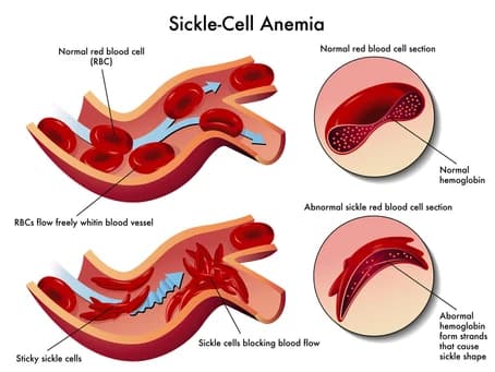 This is how the Sickle-cell blood looks like