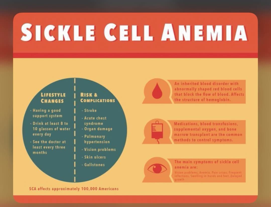 5 sickle cell anemia Home remedies